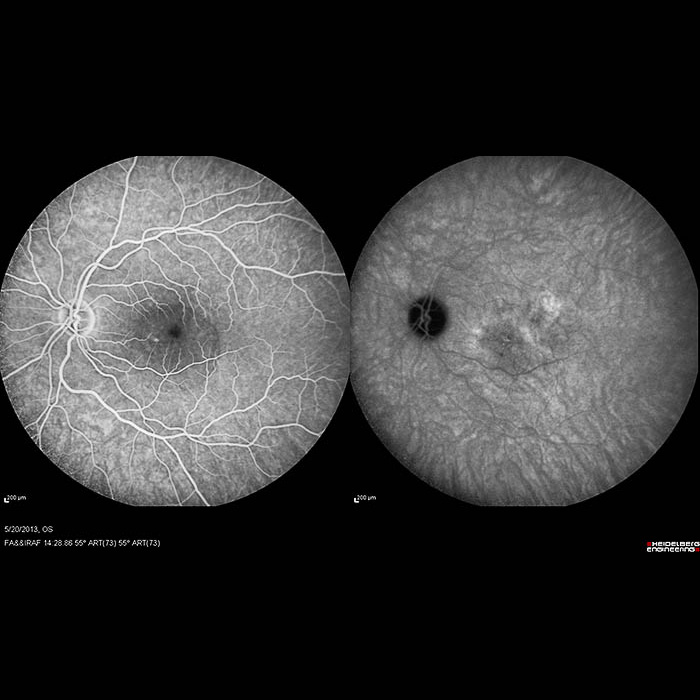 Angiografia Fluoresceínica