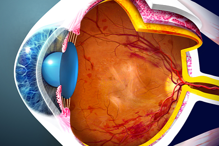 AvanÃ§os na Retinopatia DiabÃ©tica